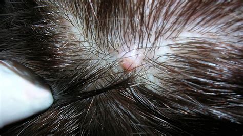 Папиллома на козелке уха - симптомы, лечение, профилактика
